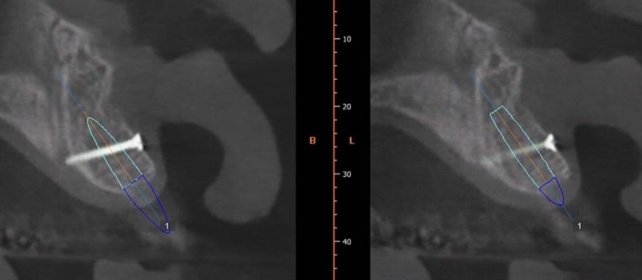 after block bone graft, screw in place