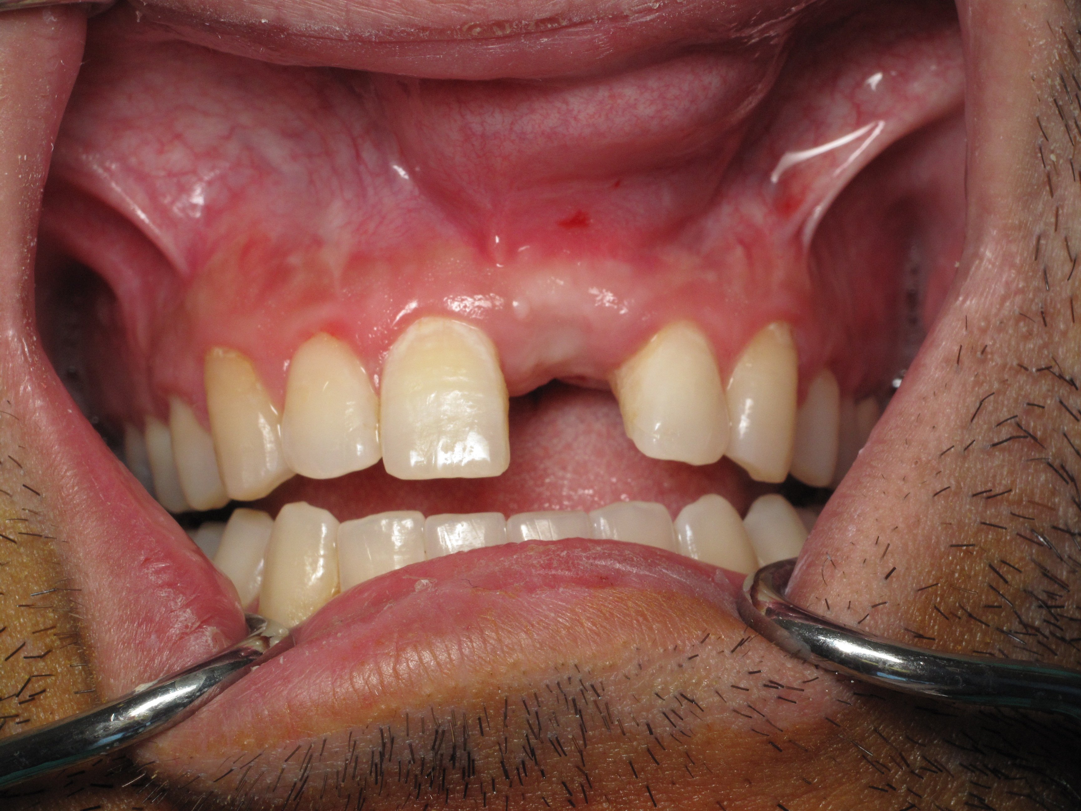 after block bone graft