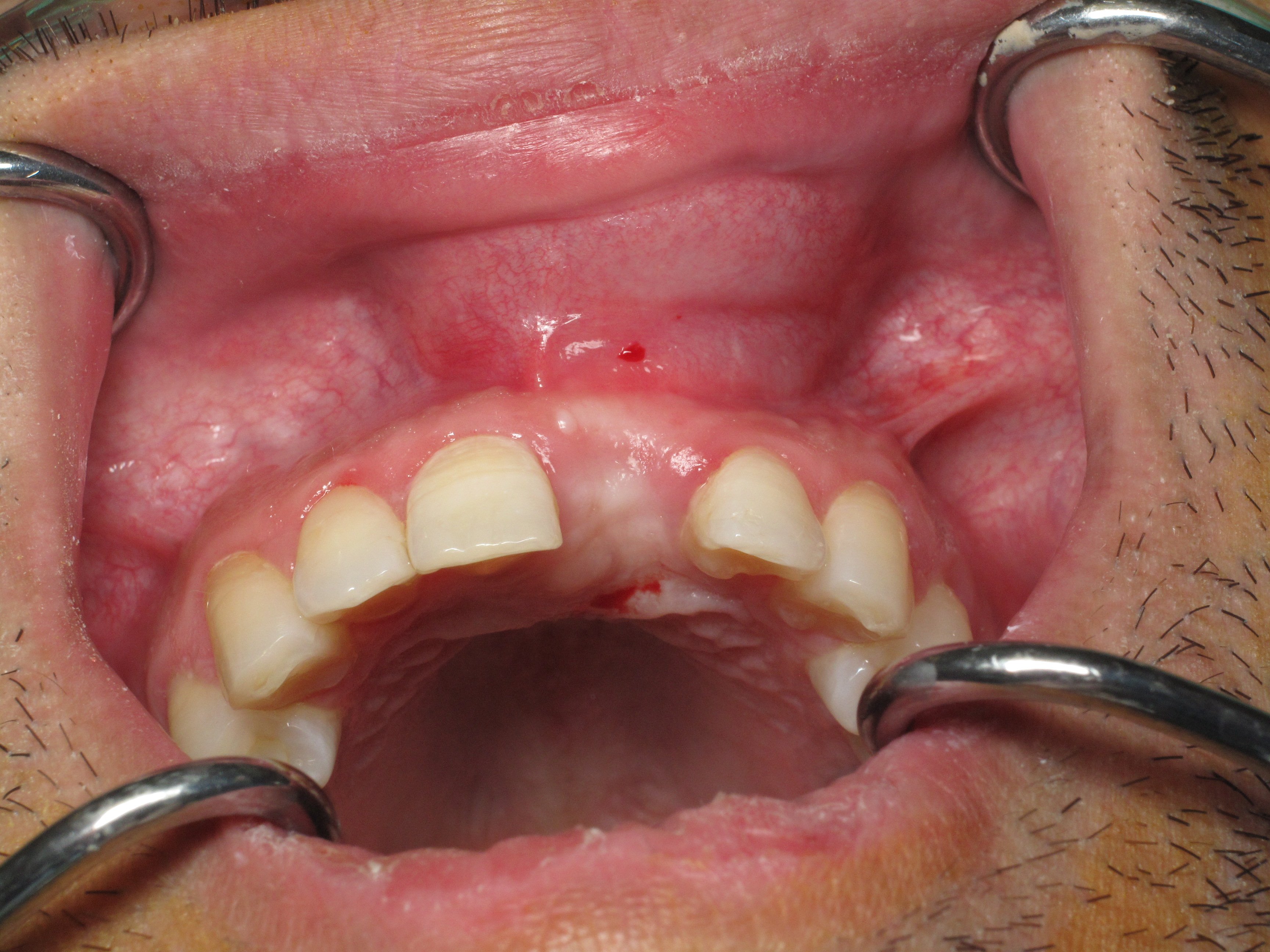 block bone graft Ramsey Amin DDS front tooth (6)