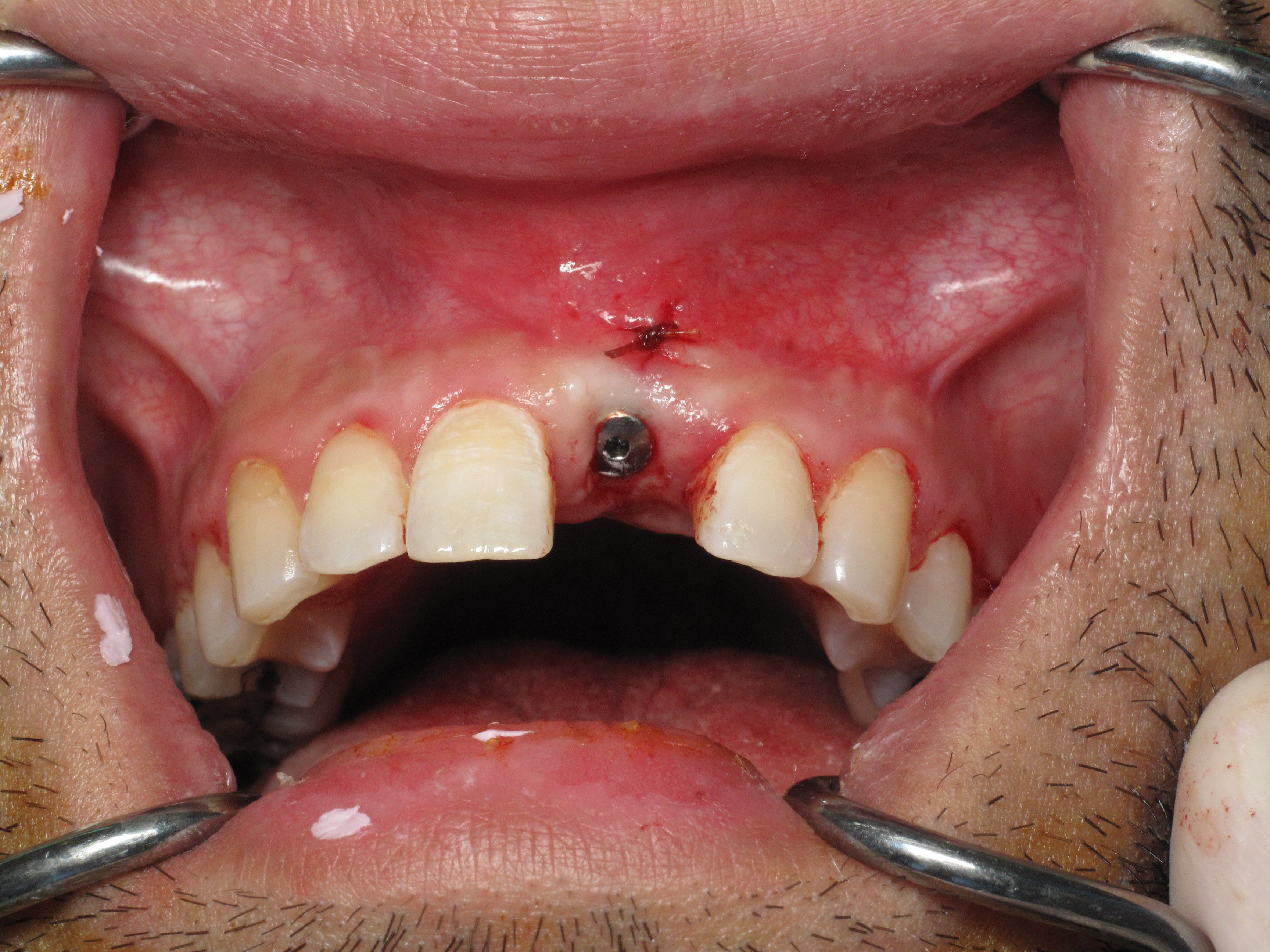 After block bone graft --Implant placed --DAY OF SURGERY PHOTO