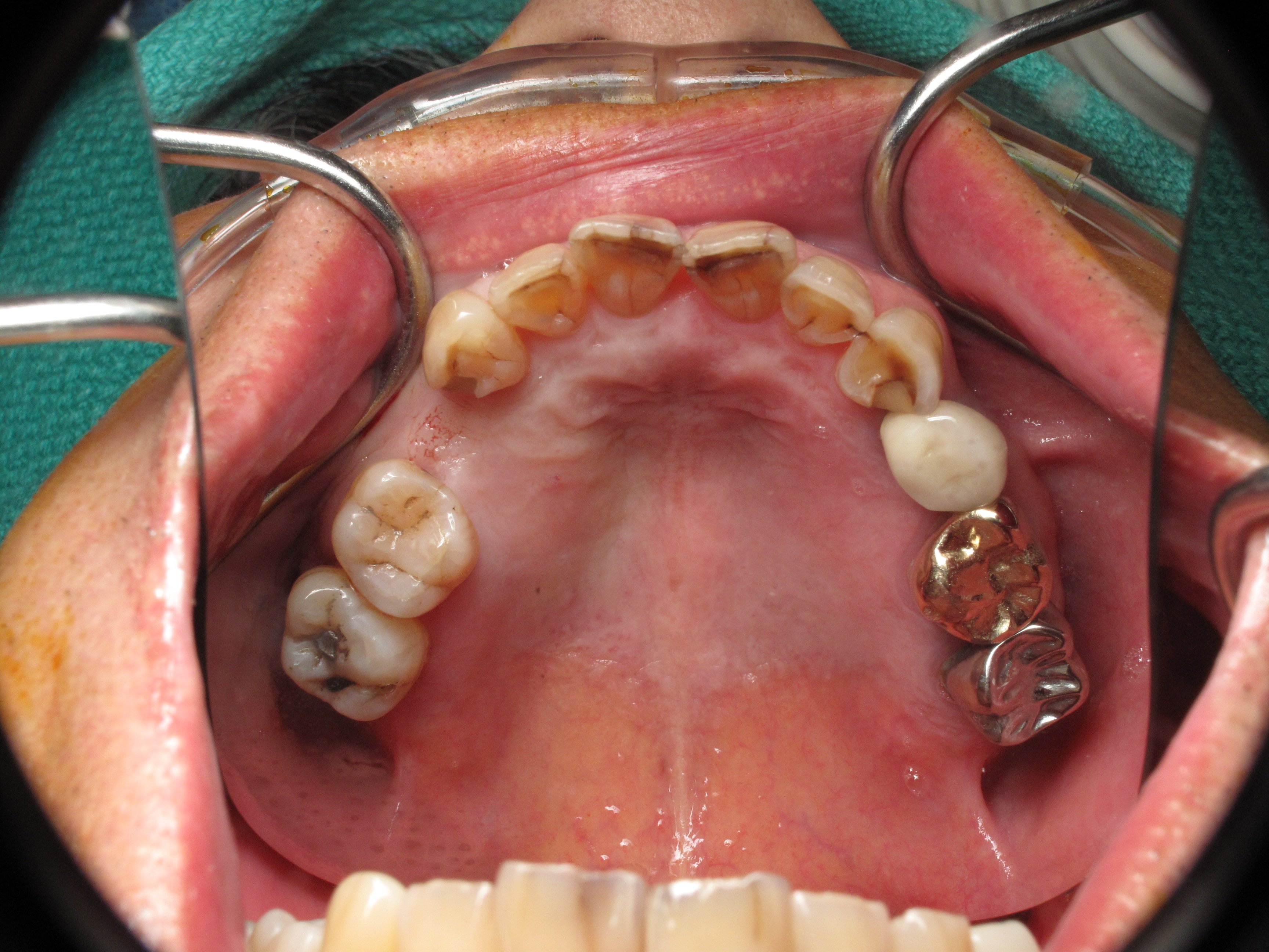 After block bone graft --Wide bone now