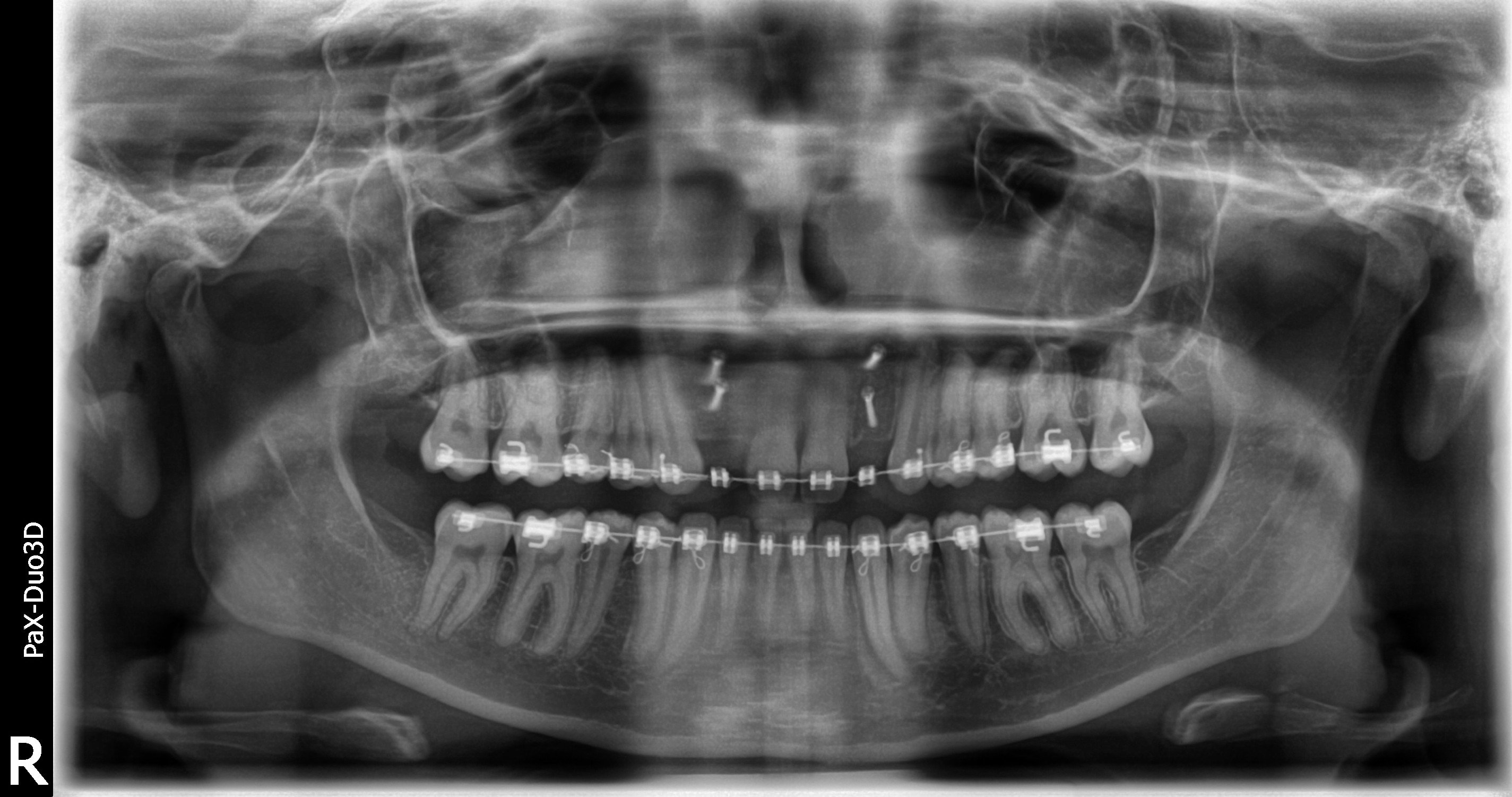 After bone graft -- four screws holding in the blocks