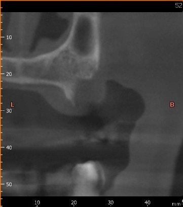 before block bone graft -Missing bone
