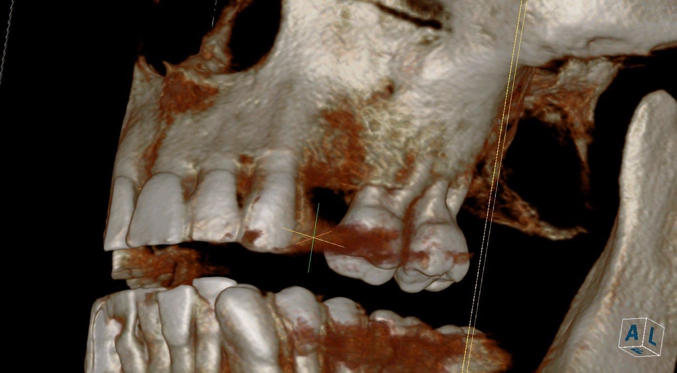 3d scan --after block bone graft