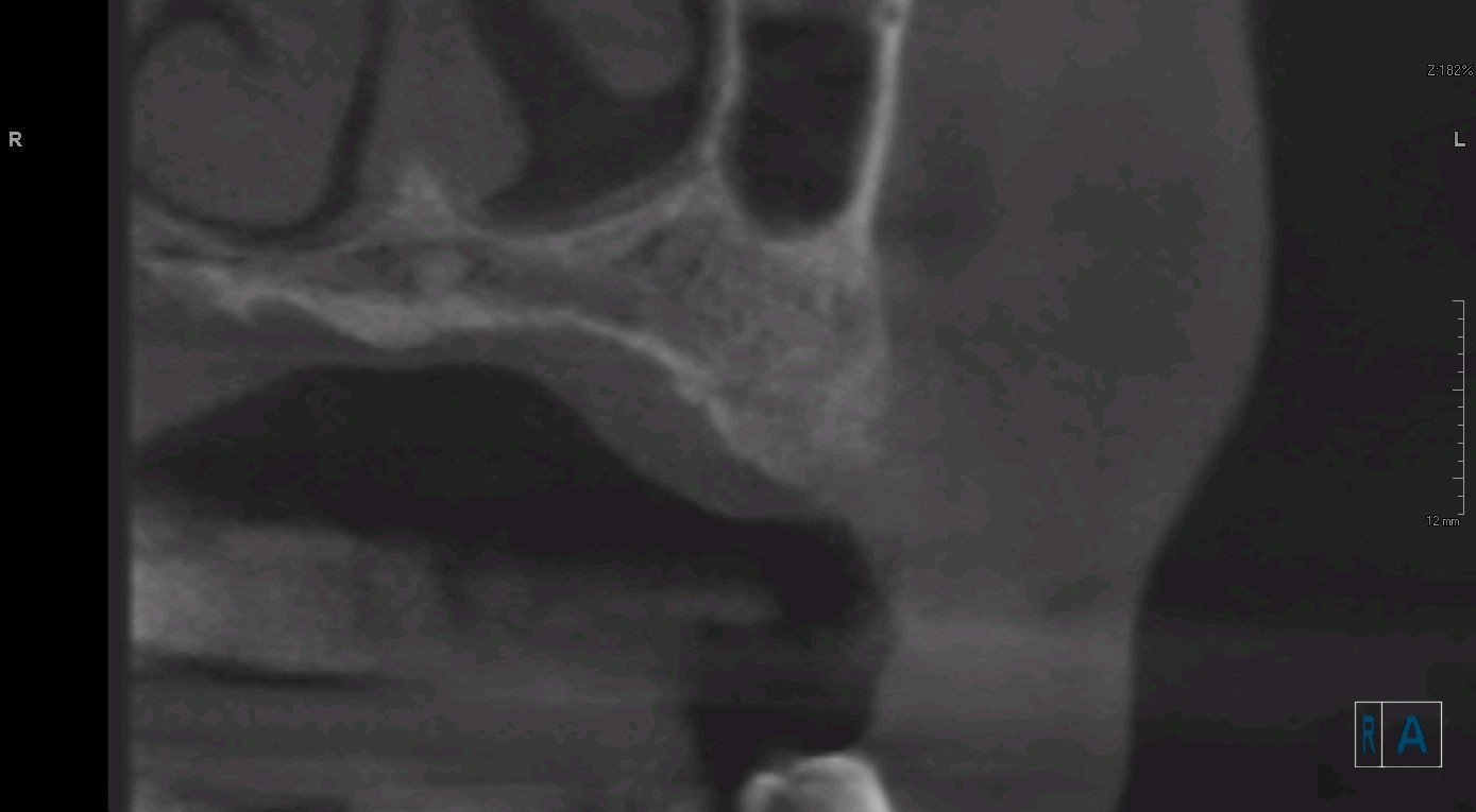 pre molar block bone graft Ramsey Amin DDS (3)