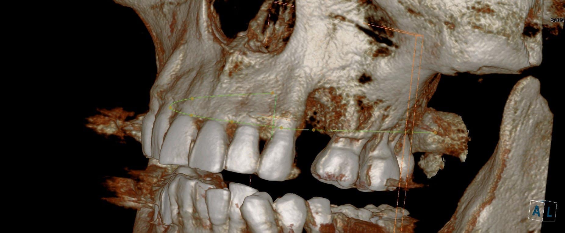3d scan --before block bone graft