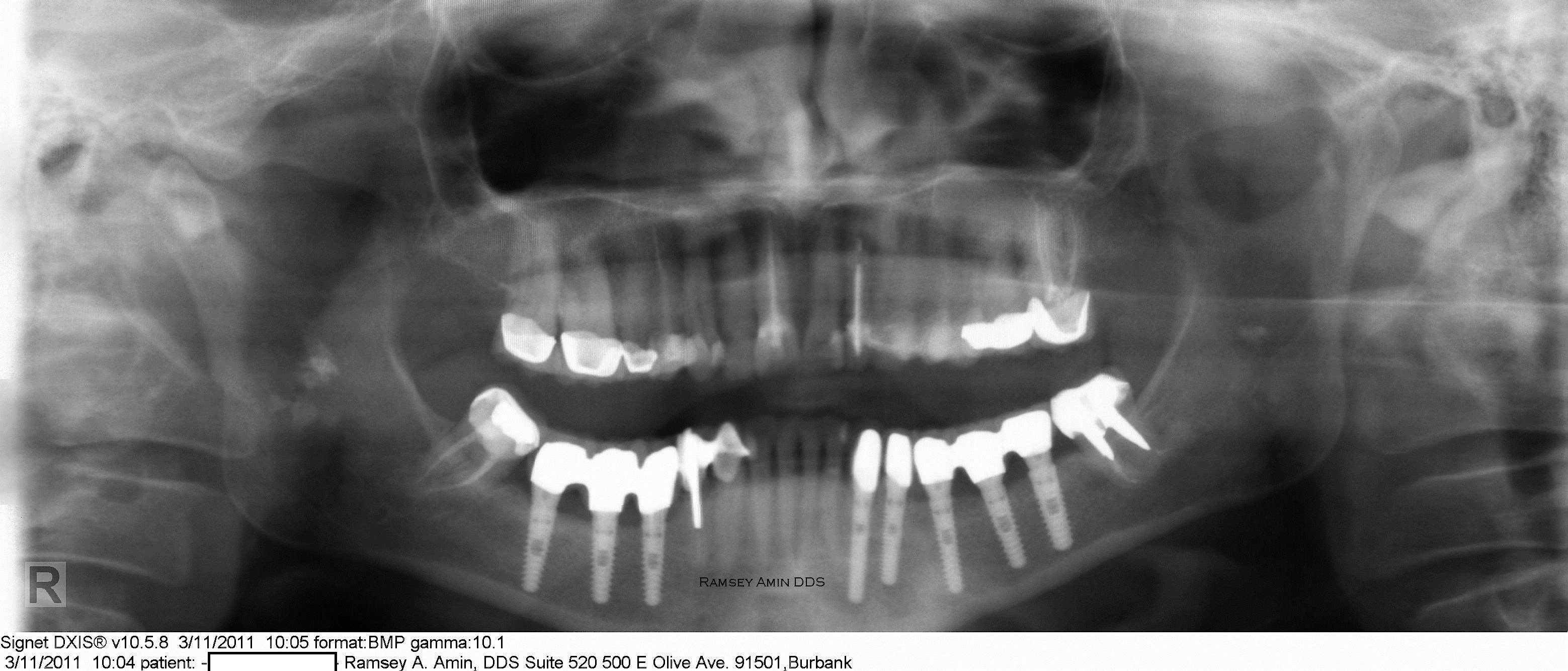 Nerve Reposition Lower Dental Implants Ramsey Amin DDS Ramsey