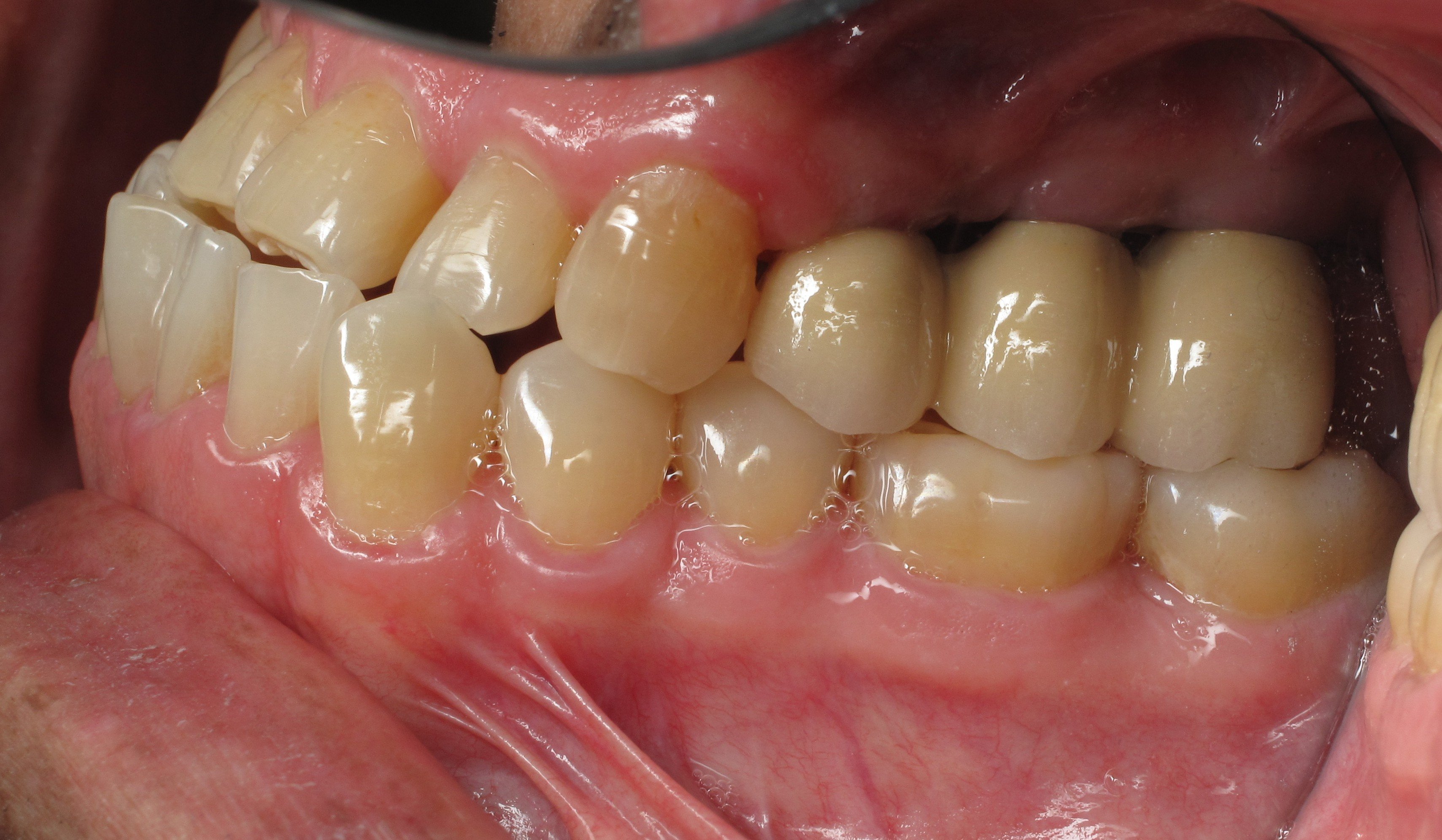 Upper Molar Dental Implants to Replace Missing Teeth Case Study Dr