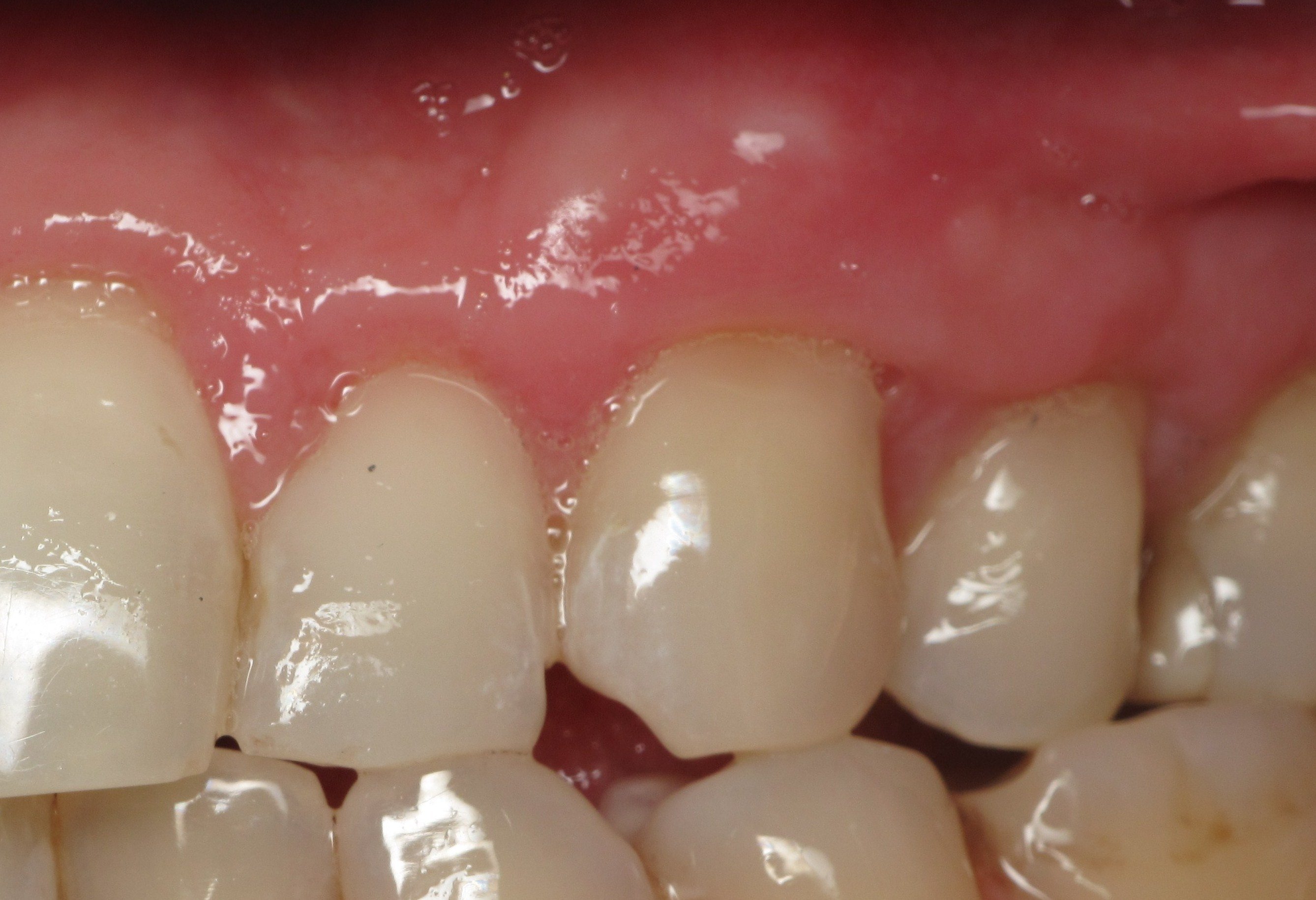 Thin Receding Gums And Dental Implants What's Important? Video by