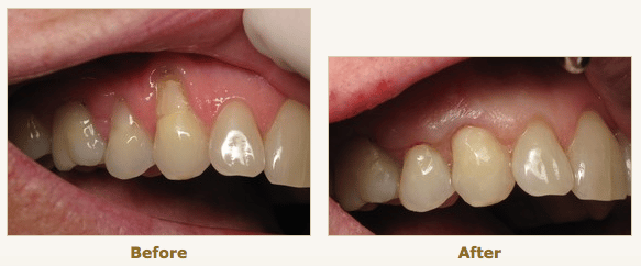 gingival recession