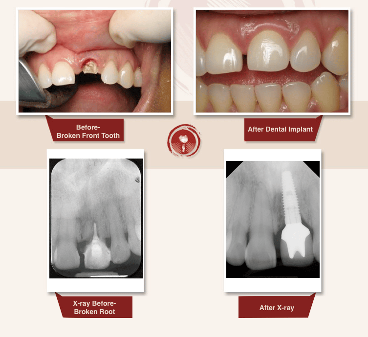 Dental Implants Smile Gallery Dental Trauma Reconstruction Ramsey