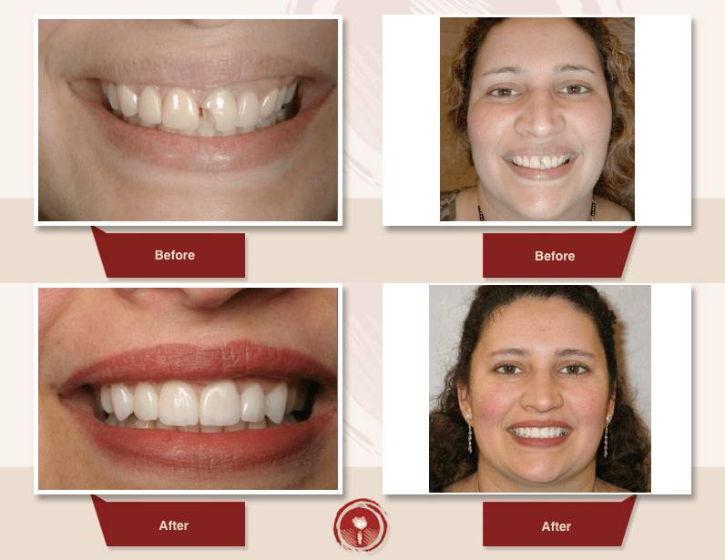 Cosmetic and Restorative Smile Gallery Porcelain Veneers Ramsey A