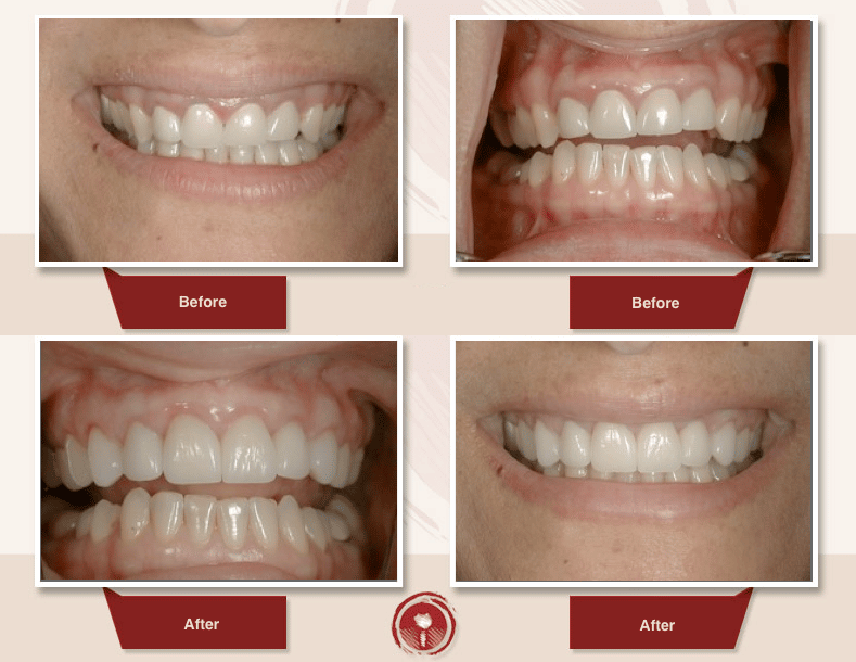 How Much Is A Crown >> Gum Disease Treatment Smile Gallery Crown Lengthening Ramsey A How Much Is A Crown >> Gum Disease Treatment Smile Gallery Crown Lengthening Ramsey A