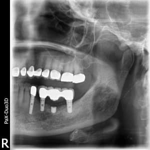 treatment of bone loss on dental implant
