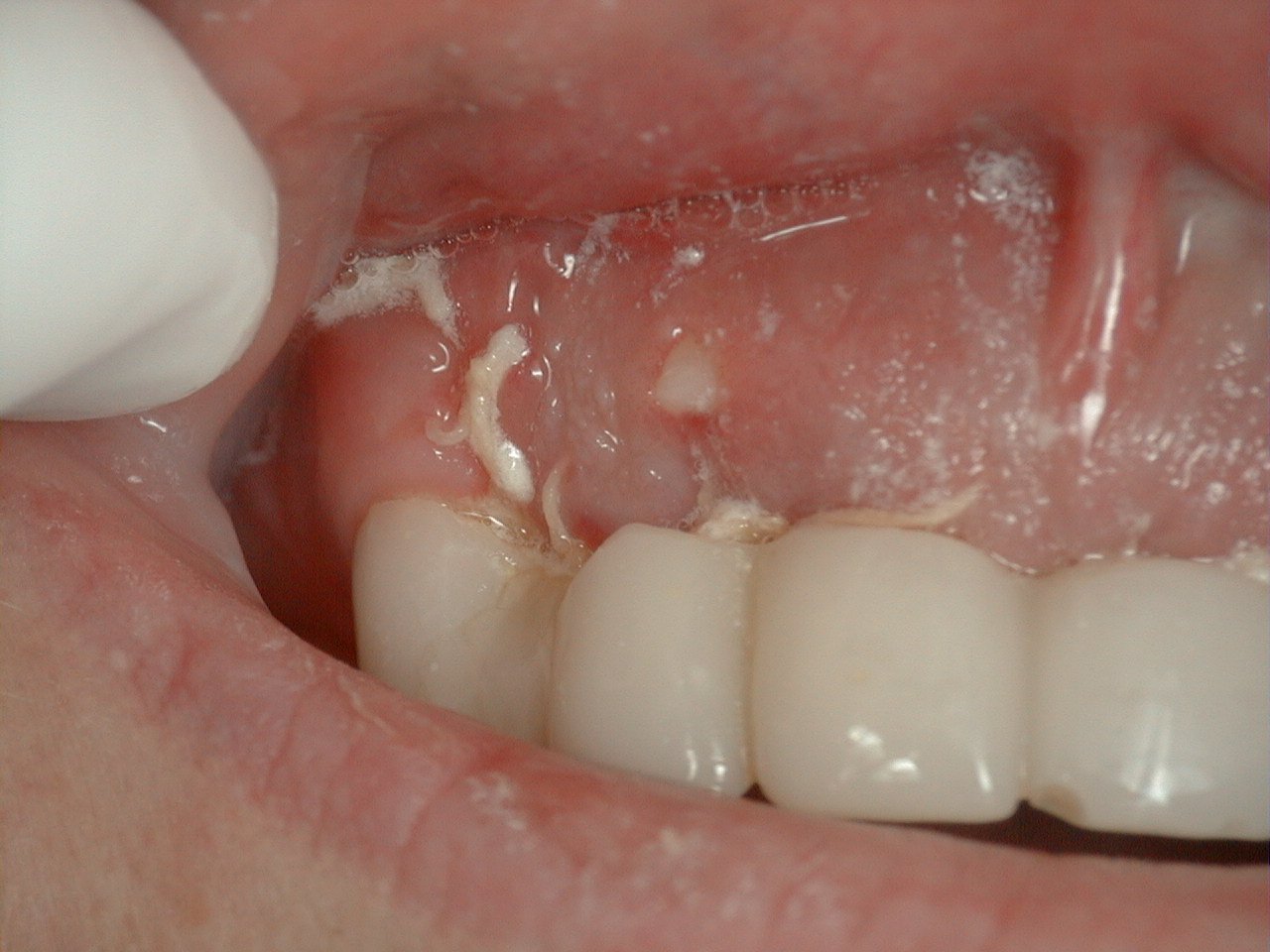 Bone Spicules After Tooth Extraction What You Need To Know Bone Spicules After Tooth Extraction What You Need To Know