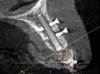 After bone graft -- four screws holding in the blocks