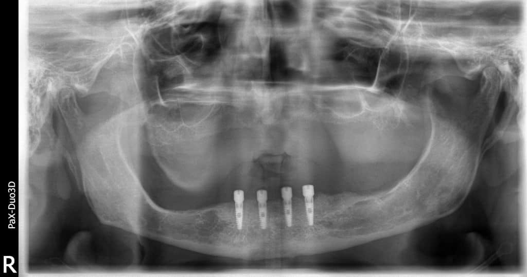 Bone reduction alveoloplasty example (3)