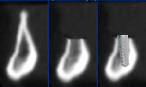 stimulation of bone reduction leveling to take off the skinny part of the jawbone. This is the jawbone in cross section.