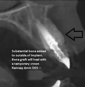 Correction of bone loss on dental implant--Ramsey Amin DDS