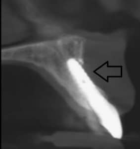 bone loss on dental implant prior to correction by Ramsey Amin DDS