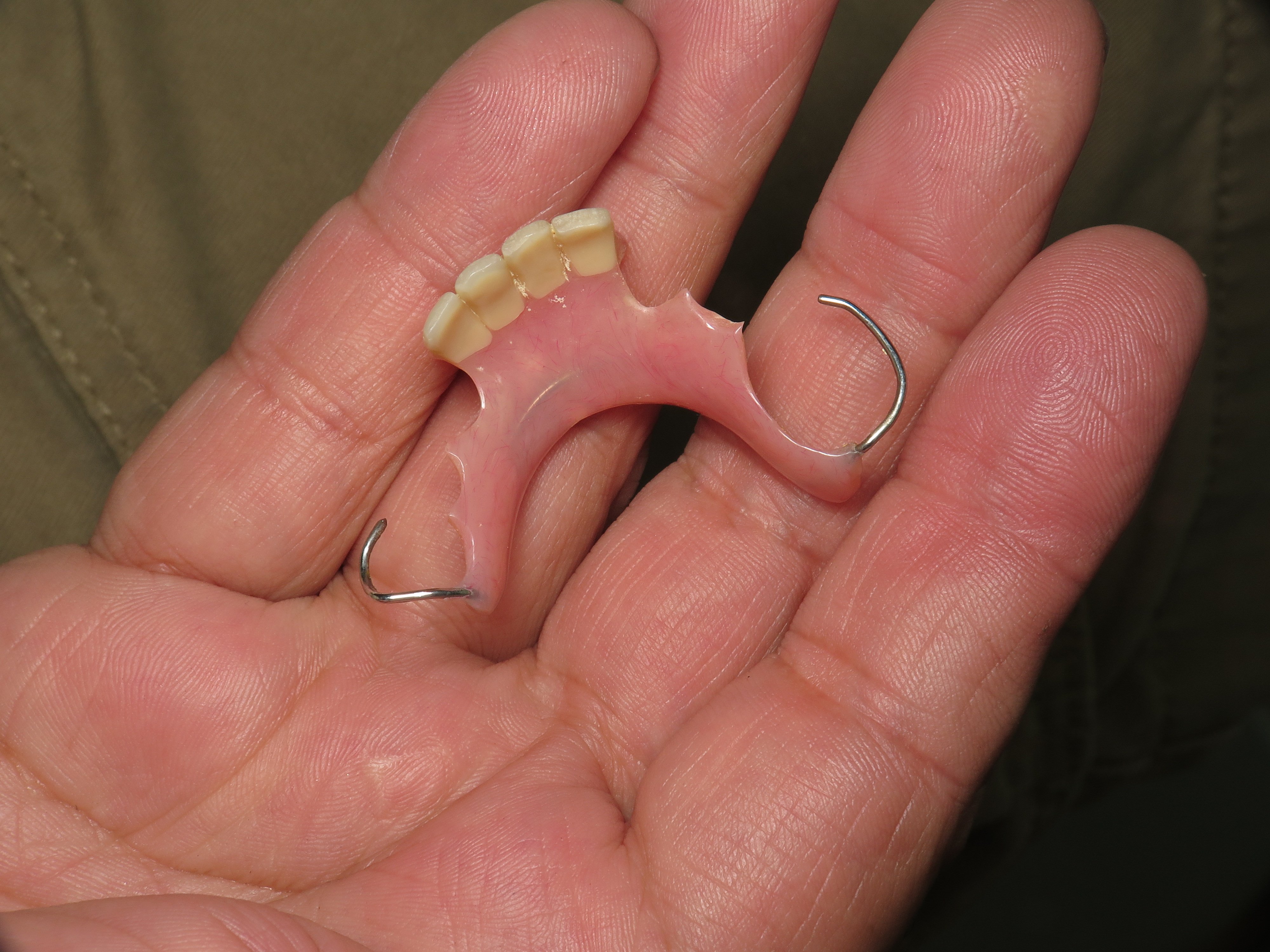 Implant For Bottom Front Tooth Trauma Root Canal Tooth Snaps Temporary Denture Duluth Ga Dental Education Lecture