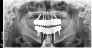 Final x-ray with upper and lower solid zirconia Bridges on 12 implants. There are 24 teeth supported by these 12 implants.