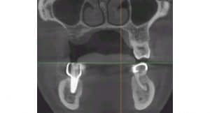 molars