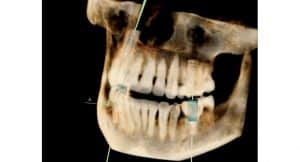 molars2