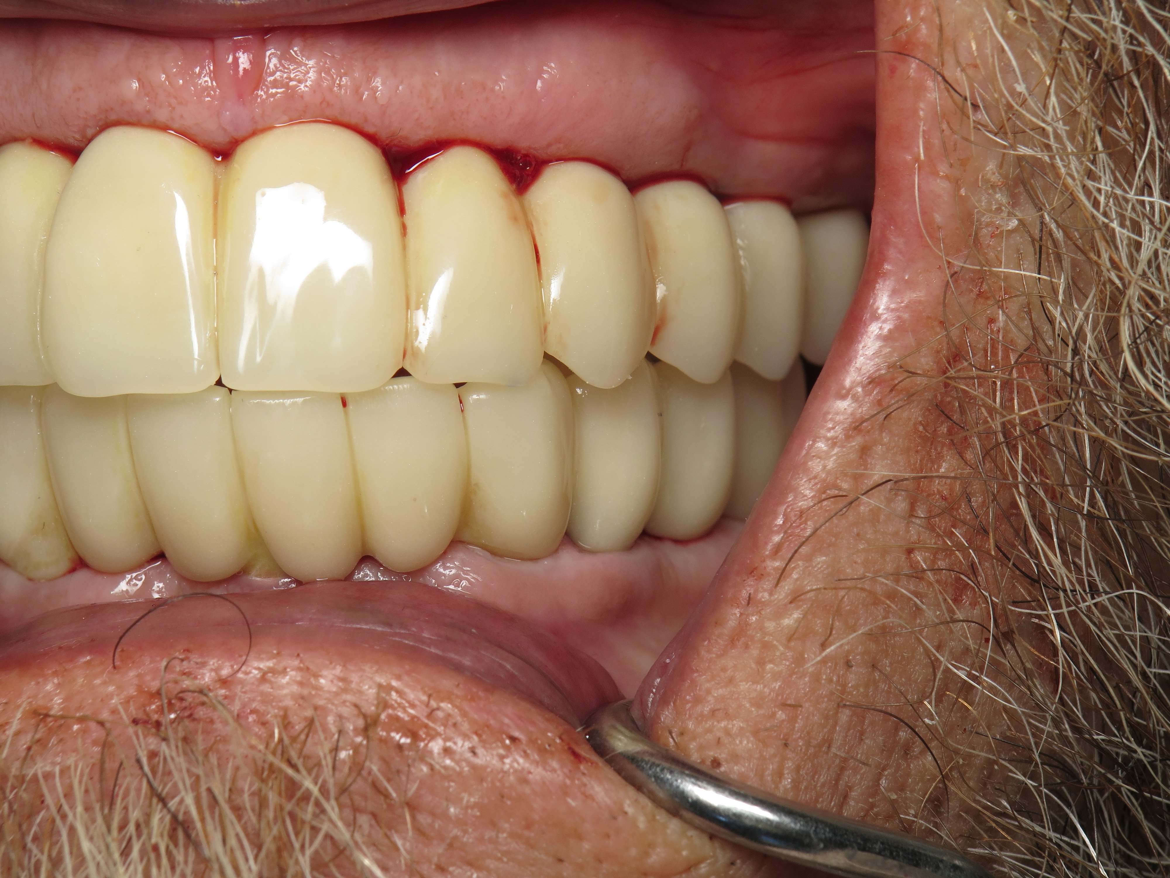 Converting Bad Dental Implant Overdentures To Fixed Full Arch Bridges