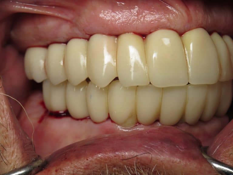 Converting Bad Dental Implant Overdentures To Fixed Full Arch Bridges