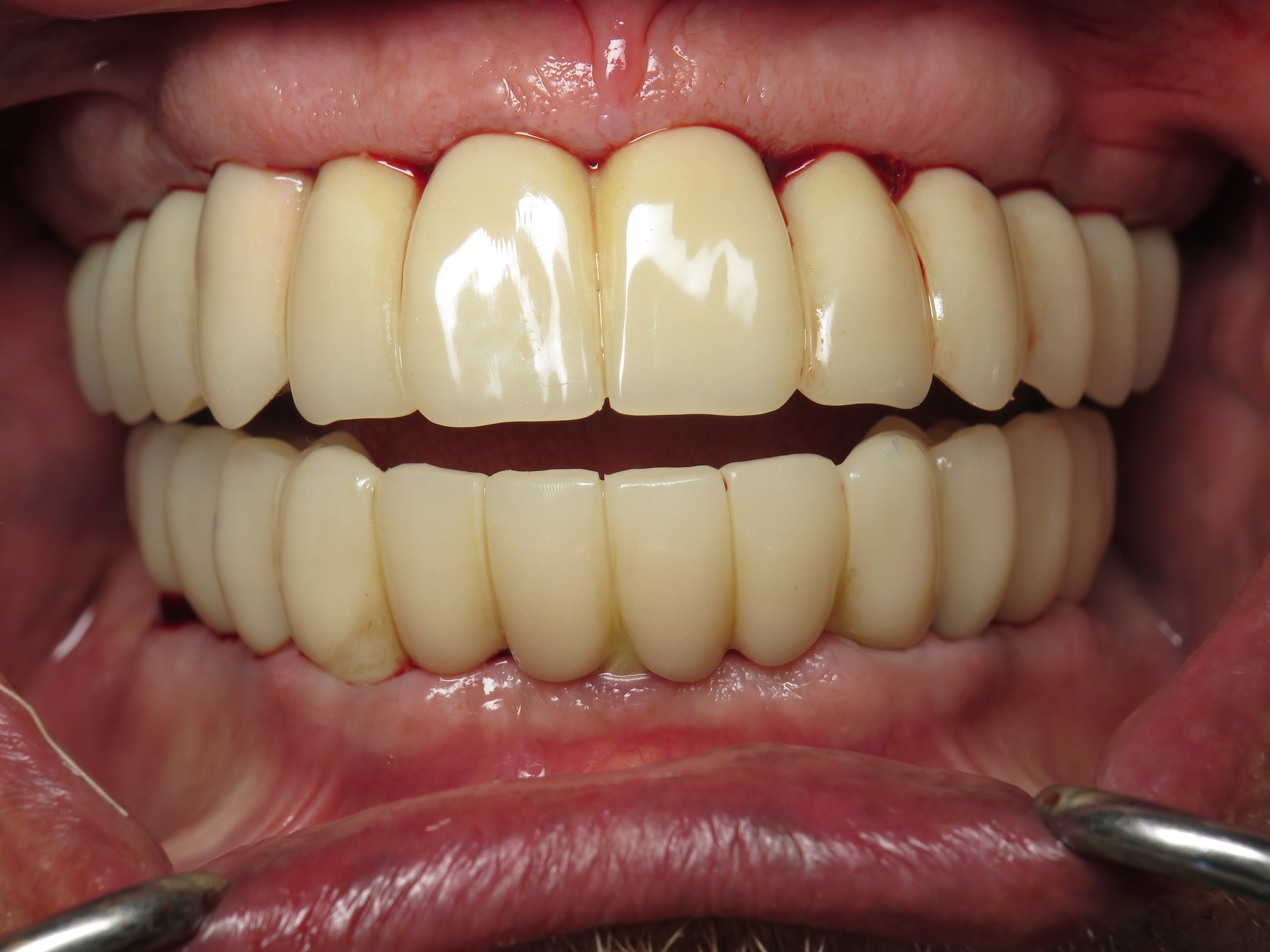 Converting Bad Dental Implant Overdentures To Fixed Full Arch Bridges