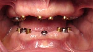 after healing on the 17 dental implants--the Gold abutments aren't locators used by the previous dentist attempt at making teeth.