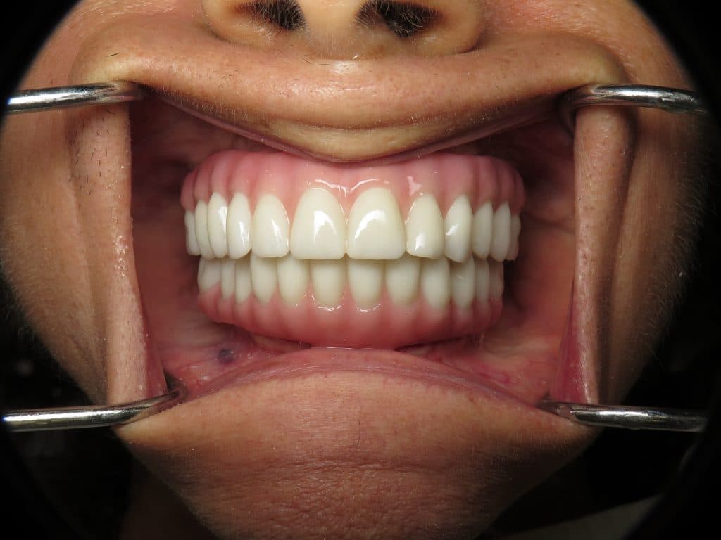 All on 4/6 Prettau Fixed Implant Bridge Lip and Facial Support