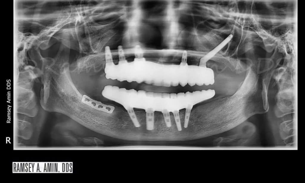 Zygomatic Implant with Blade implant