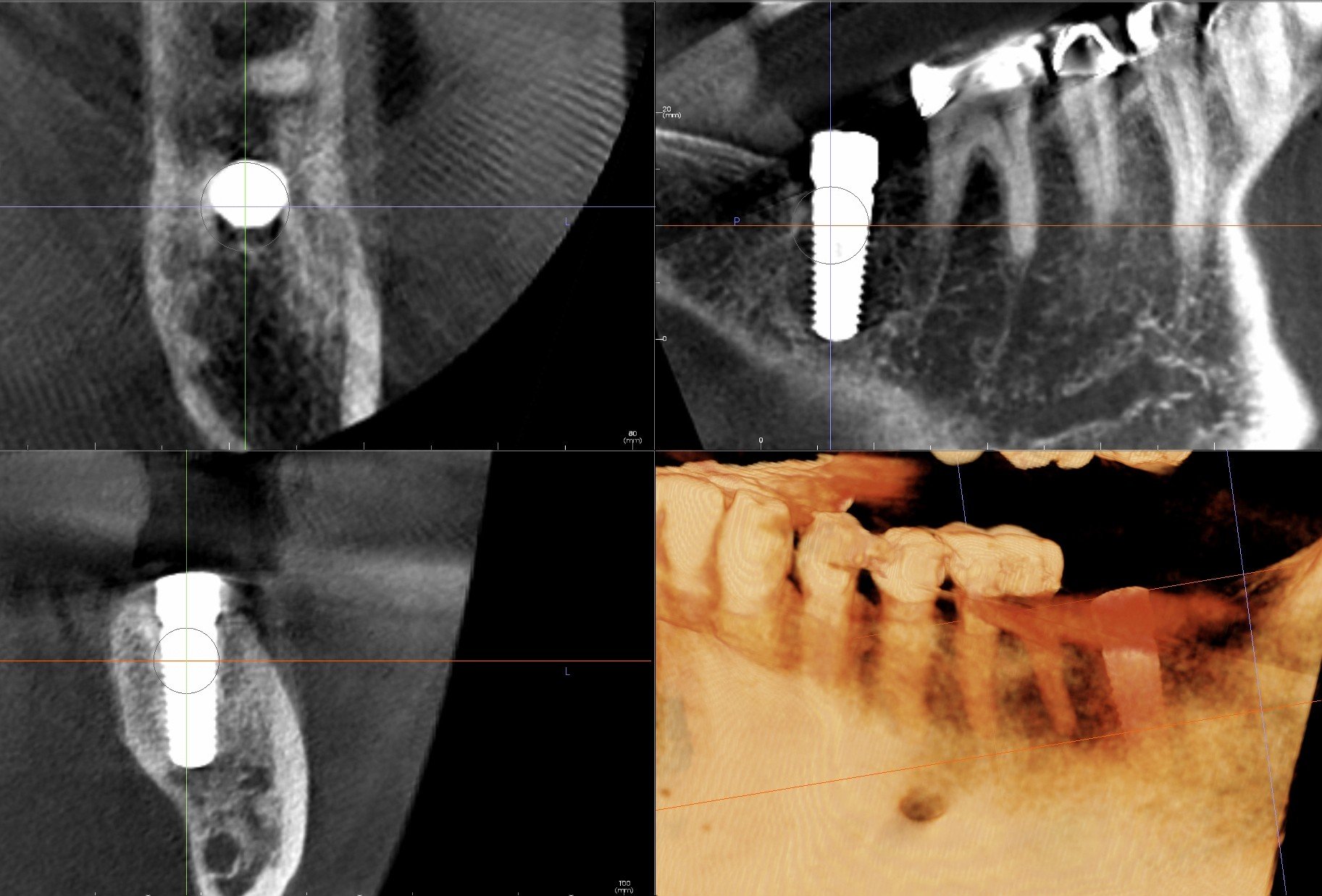 Second Molar Dental Implant 18 with Extraction and Bone Graft Ramsey