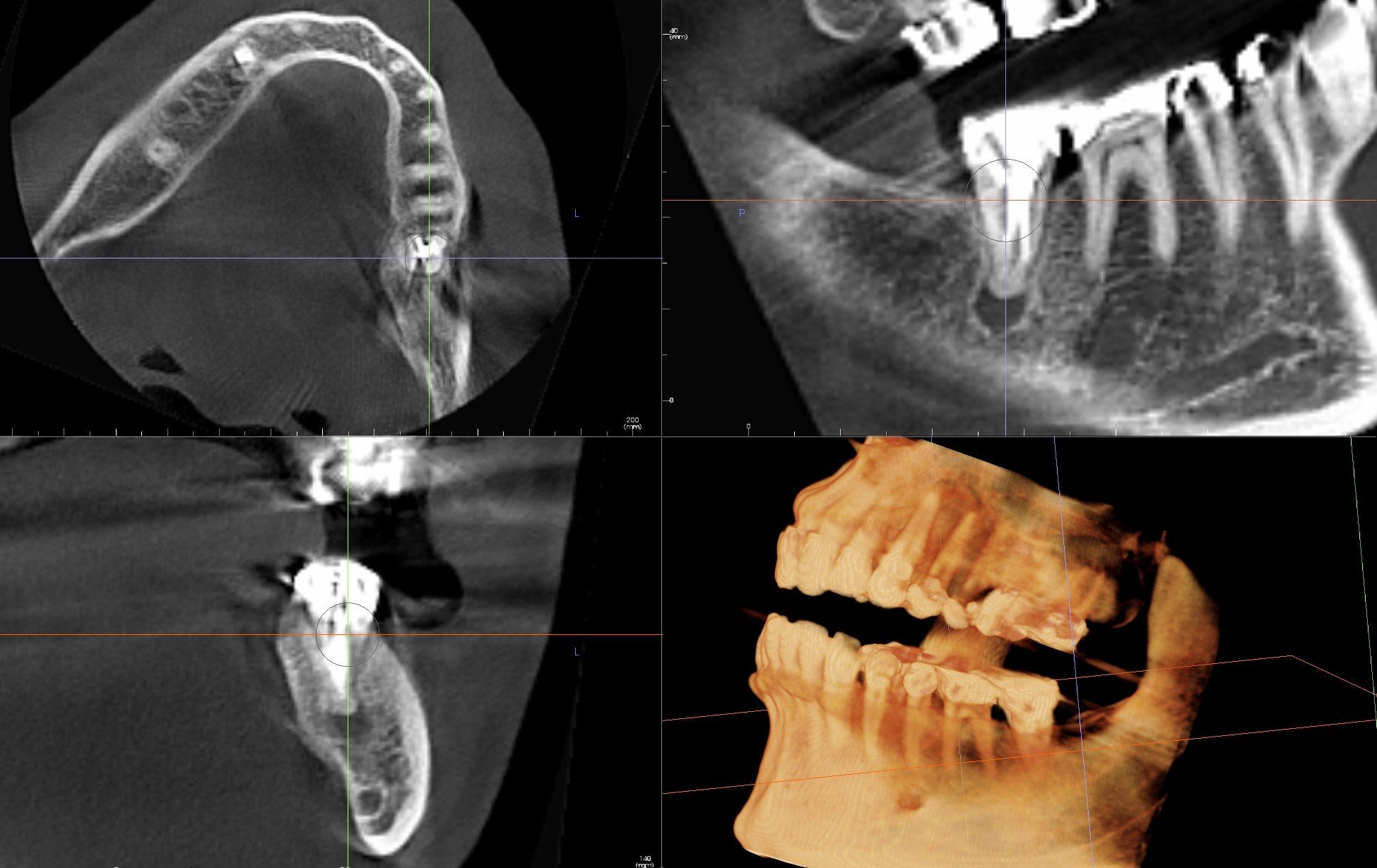 Second Molar Dental Implant 18 with Extraction and Bone Graft Ramsey