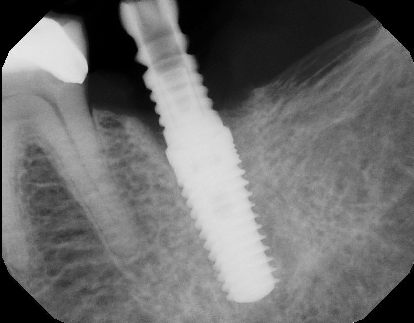 Second Molar Dental Implant 18 with Extraction and Bone Graft Ramsey