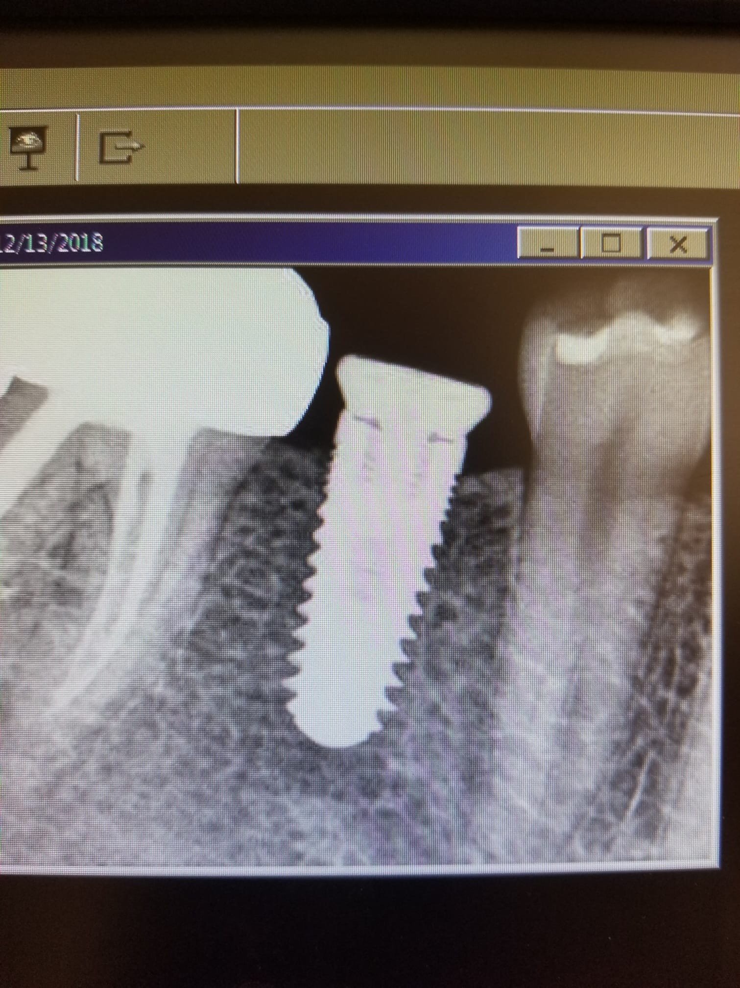 Dental Implant Too Shallow Complication…Not Deep Enough Ramsey Amin, DDS