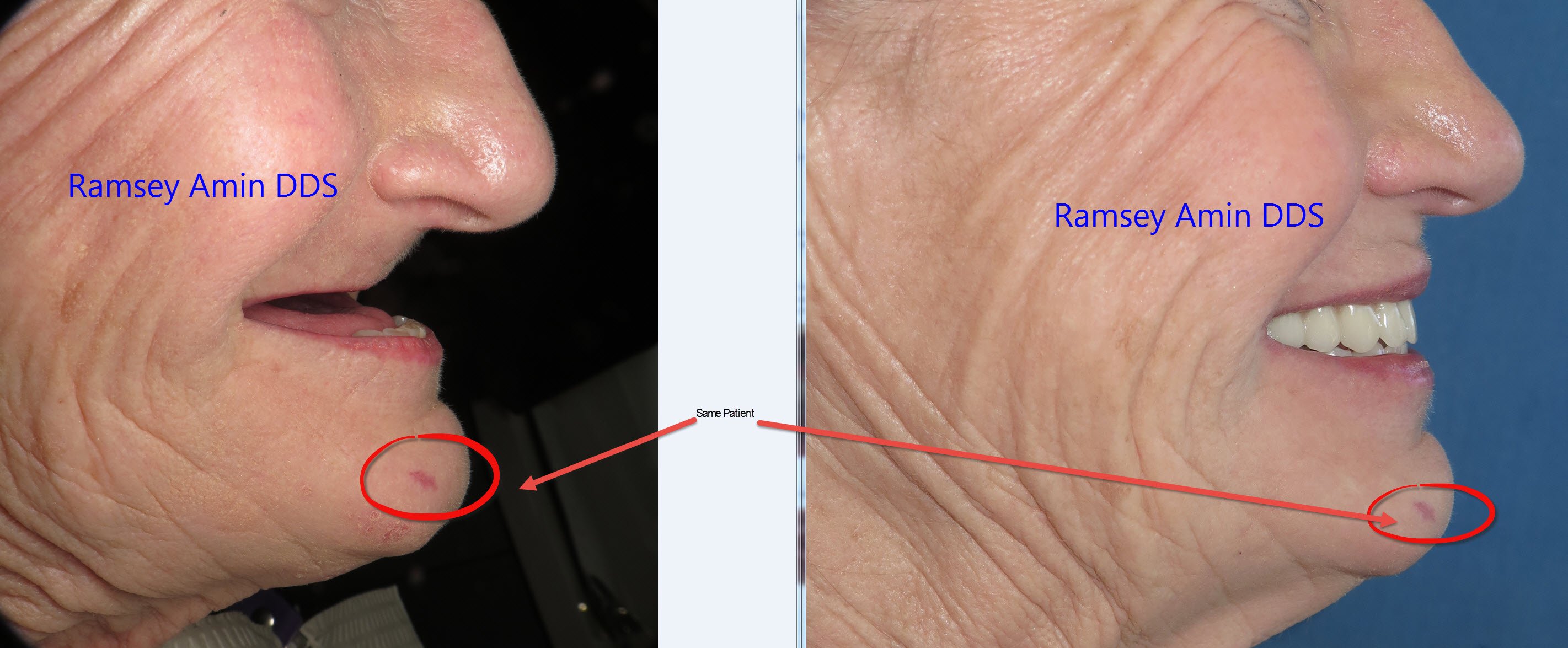 Zygomatic Lip and Face Support Ramsey Amin DDS Ramsey A. Amin, DDS