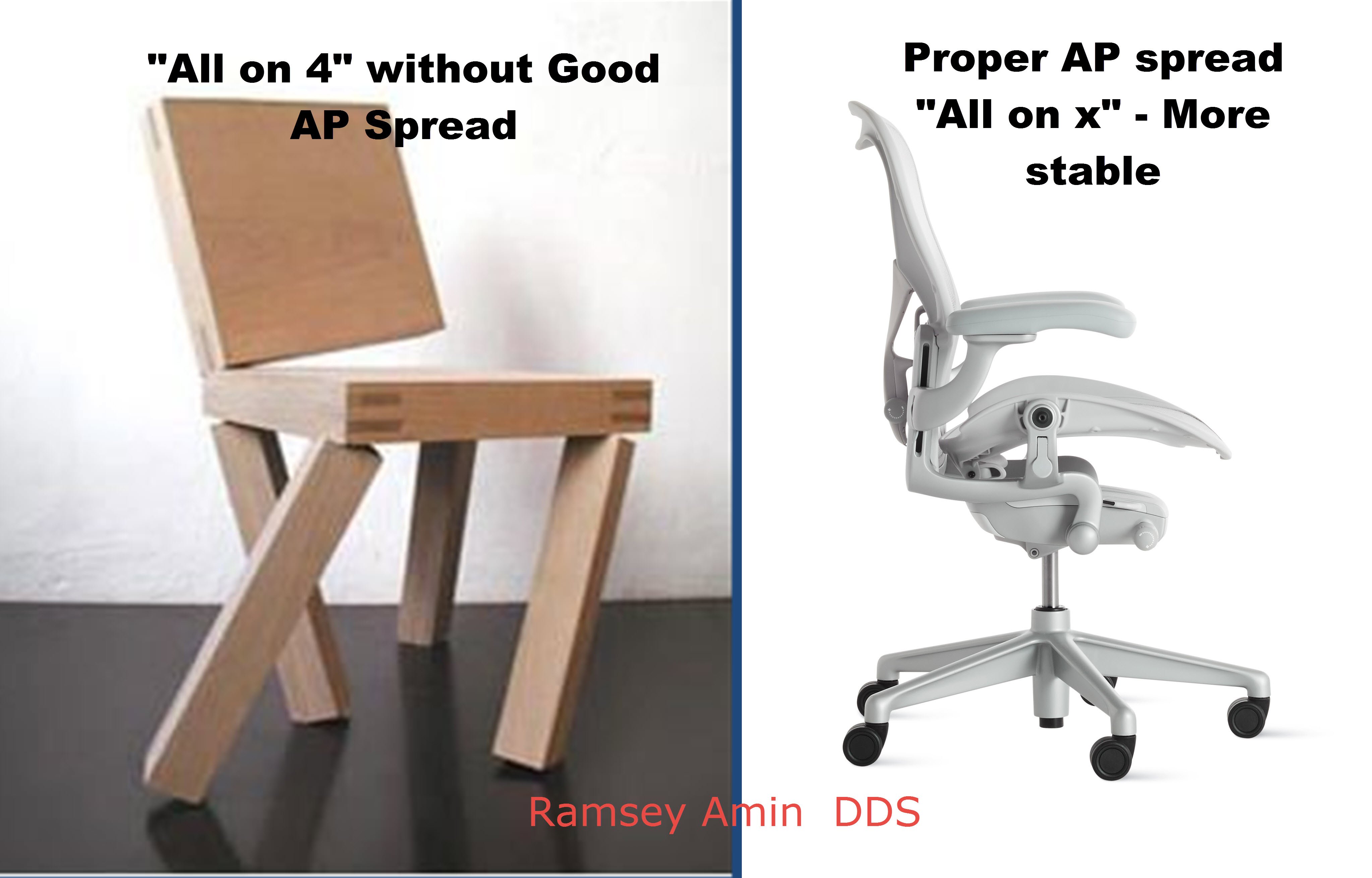 Dental Implant AP Spread for Upper 