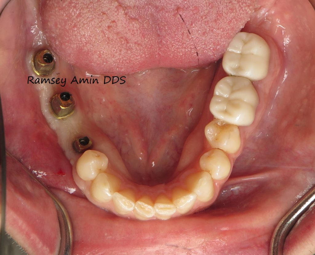 Big Bone Graft For Molars Ramsey Amin, DDS