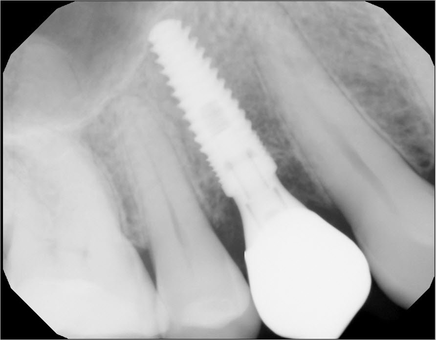 Immediate Premolar Dental Implant Ramsey Amin, DDS