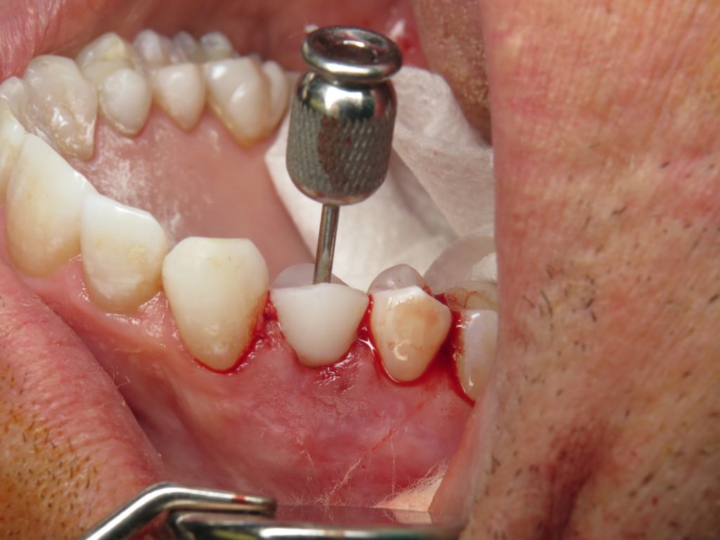 Immediate Premolar Dental Implant Ramsey Amin, DDS