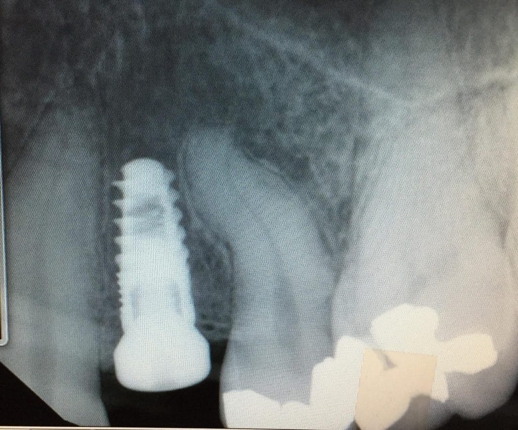 Tight space for implant