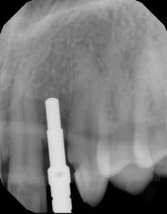 Limited implant space