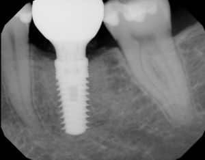 x-ray molar dental implant