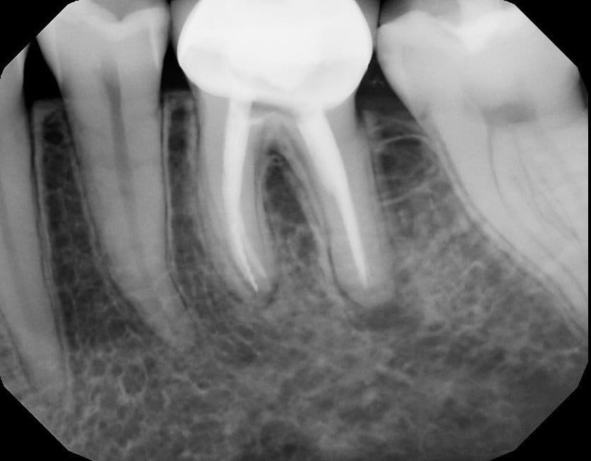 infected root canal x-ray
