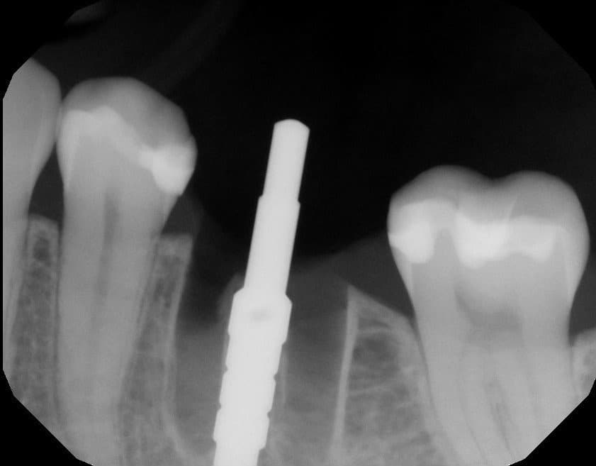 x-ray immediate molar
