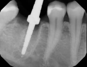 guide pin dental implant x-ray